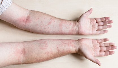 sample of Allergic contact dermatitis - male arms infected by skin disease - obrazy, fototapety, plakaty