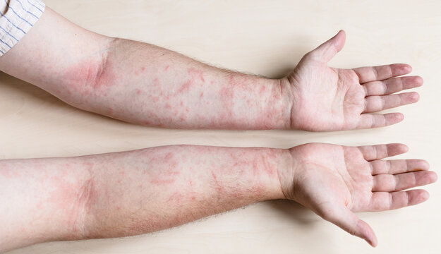 sample of Allergic contact dermatitis - male arms infected by skin disease