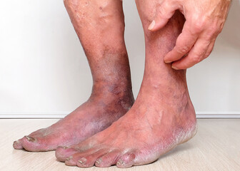 suffering from varicose veins