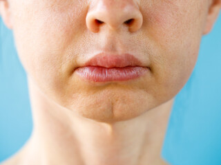 Teeth Problem. Gumboil, flux, bruise and swelling of cheek. Closeup Of Beautiful Woman with swollen...