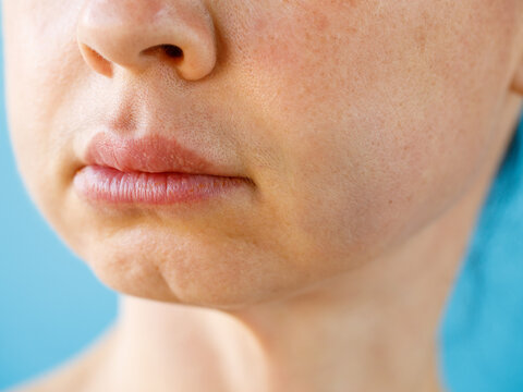 Teeth Problem. Gumboil, flux, bruise and swelling of cheek. Closeup Of Beautiful Woman with swollen cheeks. Attractive Female Feeling Painful Toothache, Dental Health And Care Concept macro