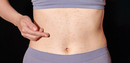 Red allergic rash on belly skin, atopic dermatitis, eczema, inflammation. Woman applying ointment