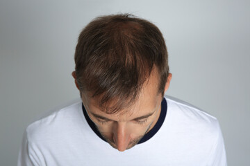 Man with hair loss problem on light grey background, above view