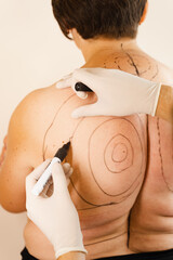 Markup fat woman before kyphosis surgery. Dowager hump. Surgeon is marking back of woman for...