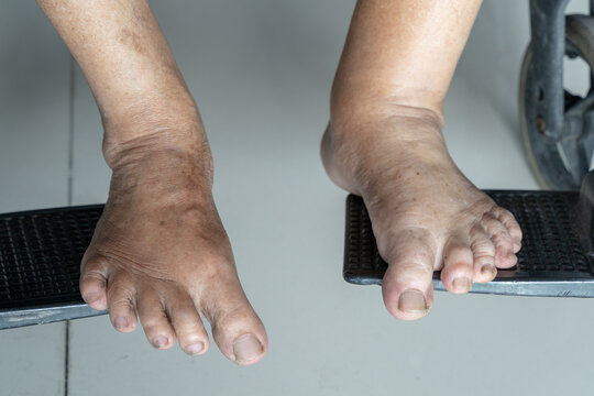 swollen feet images
