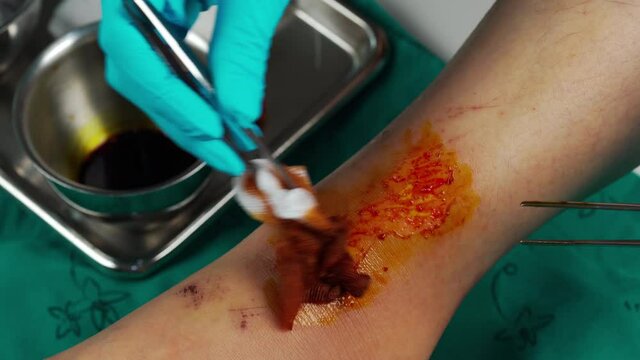 close up doctor cleaning wound on the leg by iodine tincture, Injuries from falling