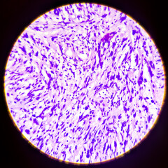 Photomicrograph (microscopic image) from breast mastectomy specimen showing phyllodes tumor (cystosarcoma phylodes)