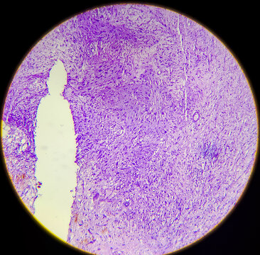 Photomicrograph Of A Malignant Peripheral Nerve Sheath Tumor (neurogenic Sarcoma), A Type Of Cancer Derived From Peripheral Nerves