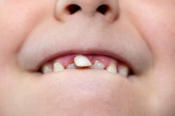 Little boy with open mouth showing milk teeth in front and growing permanent teeth.