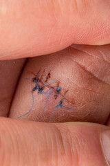 Postoperative sutures on the finger of the hand.. Stitches on the injured finger. Photo taken under artificial light