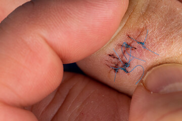 Postoperative sutures on the finger of the hand.. Stitches on the injured finger. Photo taken under artificial light