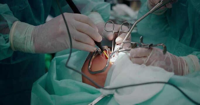  The surgeon performs a surgical operation to remove the tonsils. Pediatric surgery. Tonsillectomy. Elimination of apnea.