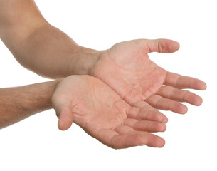 Man suffering from calluses on hands against white background, closeup