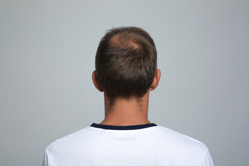Man with hair loss problem on light grey background, back view
