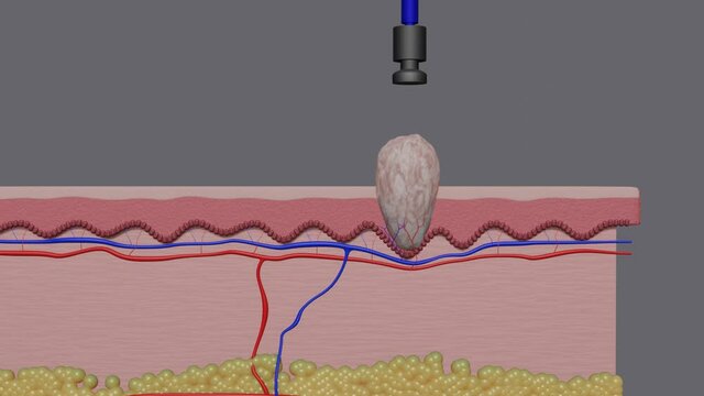 Wart | Animation of the treatment 