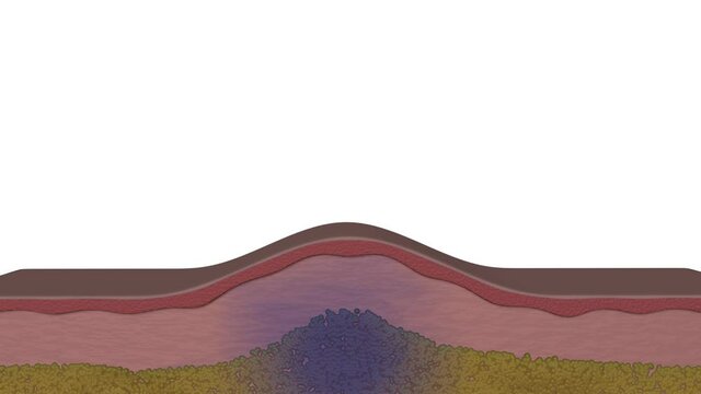 Animation of the liposuction process