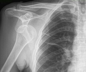 x ray image of shoulder dislocation