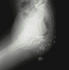 x ray image of perianal fistula 