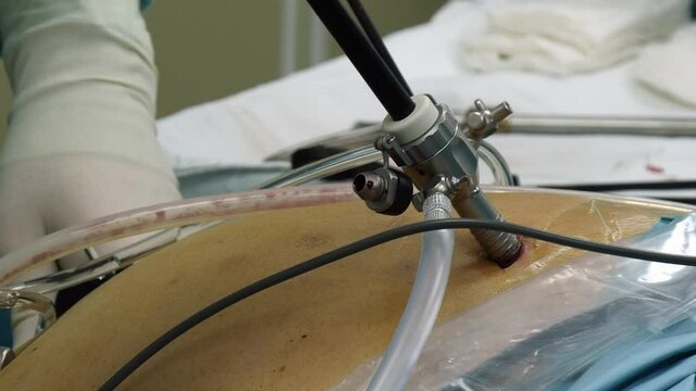 Moscow, Russia - 16 September 2016: Abdominal laparoscopy in operating room close-up. Professional medical equipment in operating room. Work of surgeon doctor.