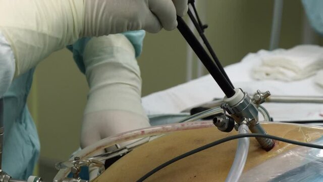 Moscow, Russia - 16 September 2016: Abdominal laparoscopy in operating room close-up. Professional medical equipment in operating room. Work of surgeon doctor.