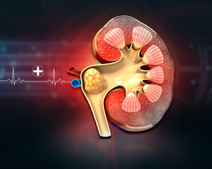 Deceased kidney on medical background. kidney kidney stones. 3d illustration.