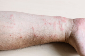sample of Allergic contact dermatitis - skin inflammation on inner side of forearm close up
