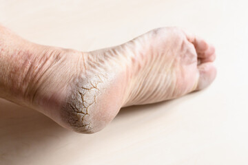 dead dry cracked skin on heel of male foot close up