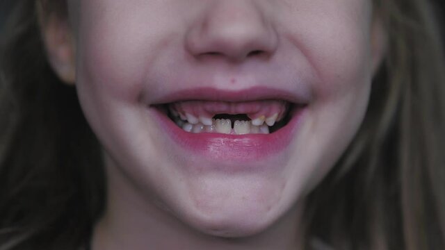 Close-up smile of a girl with lost milk teeth. Loss of deciduous teeth, replacement of permanent teeth. Children at dentistry.