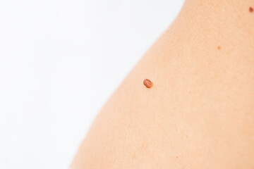 Mole to be removed. Woman body with dangerous bulging mole on a white background. Verrucous nevus. Copy space