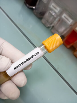 Blood sample for Serum Protein Electrophoresis(SPEP) test. medical concept, study of diseases.