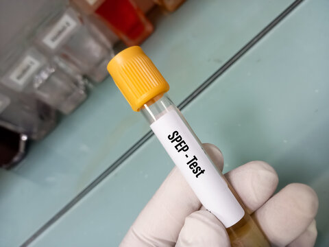 Blood sample for Serum SPEP(Serum Protein Electrophoresis) test. medical concept, study of diseases.