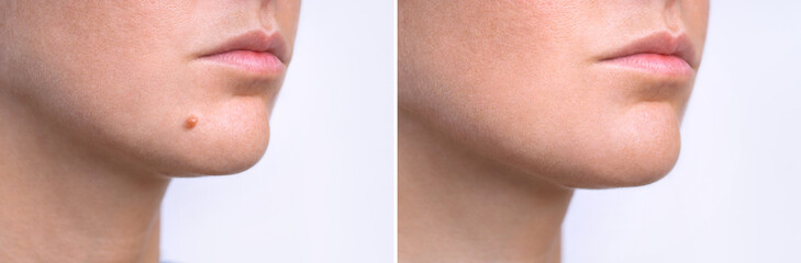 Woman face before and after mole removal. Laser treatment for birthmark removal from patient's face.