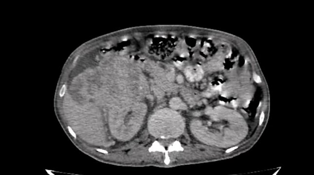 renal carcinoma, abdomen ct scan
