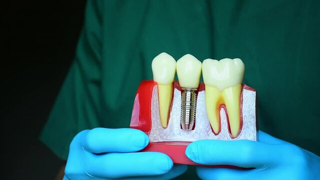 Close-up photo of implant dentistry it is a replacement for missing teeth by dentist hand.