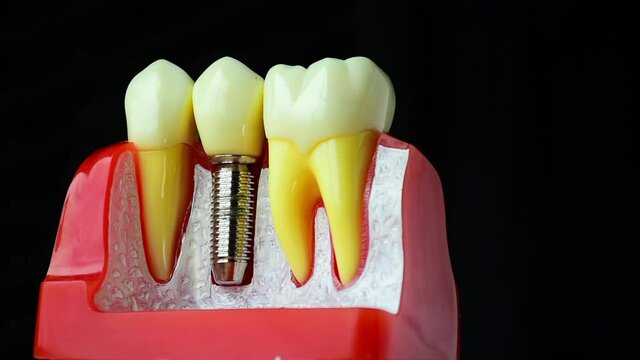 Close-up photo of implant dentistry it is a replacement for missing teeth by dentist hand.