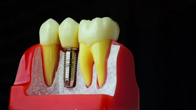 Close-up photo of implant dentistry it is a replacement for missing teeth by dentist hand.