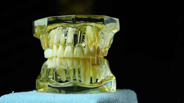 Close-up photo of implant dentistry it is a replacement for missing teeth by dentist hand.