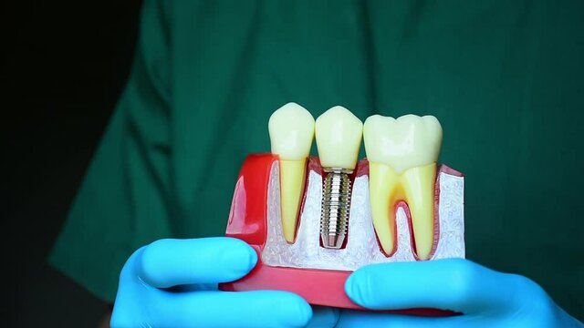 Close-up photo of implant dentistry it is a replacement for missing teeth by dentist hand.