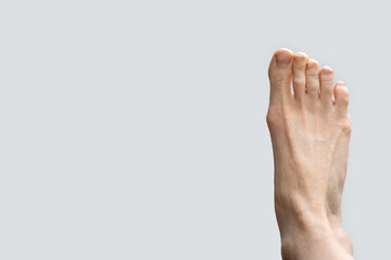 Hallux valgus, bursitis of the foot on a gray background. Fungus of the nails on the disease of the...
