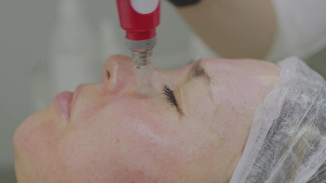 Close-up of a woman face. Needle mesotherapy procedure into the skin of the face