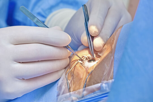 eye surgery ophthalmology cataract phacoemulsification