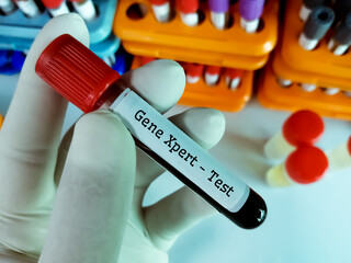 Blood sample tube for Gene Xpert test. Diagnosis for tuberculosis(TB)