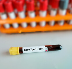 Blood sample tube for Gene Xpert test. Diagnosis for tuberculosis(TB)