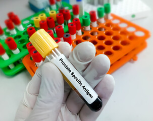 Blood sample for Prostate Specific Antigen (PSA) test, diagnosis for prostate cancer