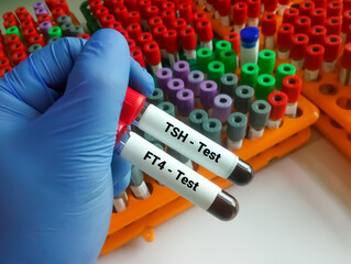 Obraz premium Blood sample for TSH and FT4 test. Diagnosis for thyroid disease