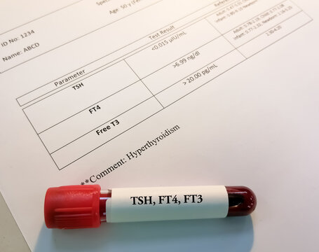 Scientist hold blood sample with report. Hyperthyroidism.