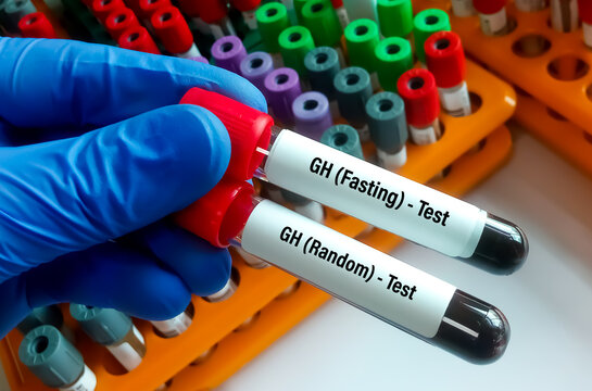 Blood Samples For Growth Hormone (fasting And Random) Test, Somatotropin