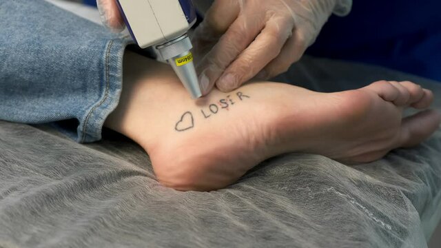 Laser removing of tattoo with words loser, lover and heart on woman's foot in red and black colours, closeup hands in gloves of doctor. Romantic tattoo symbol of youth love and disappointment in life.