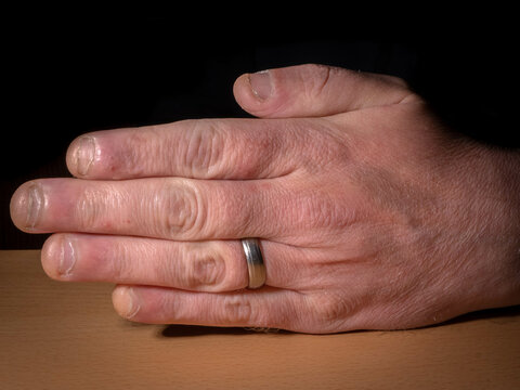 A middle aged human hand with badly bitten fingernails and wedding ring, medical illustration or societal observation