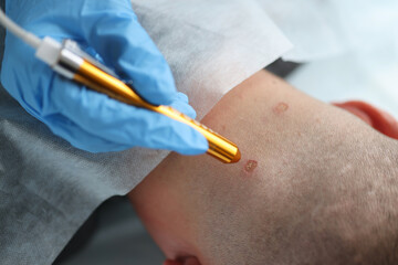 Dermatologist removes moles from patient neck with laser closeup